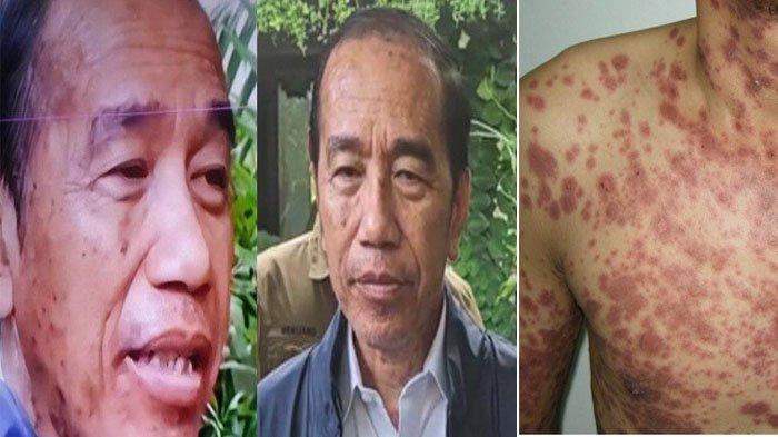 Jokowi Sakit Kulit
